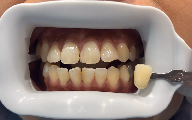 Glow Dental Bintulu teeth whitening patient smile transformation — before